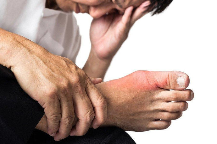 What Causes Gout & What You Can Do About It NOW